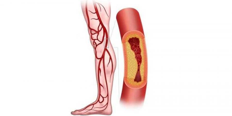 عوامل خطر تصلب شرايين الساقين