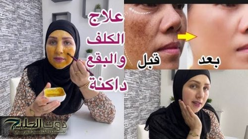 عايزة بشرة نضرة وجميلة جربي الترمس عشان تفتحي وتخلي الكلف يختفي